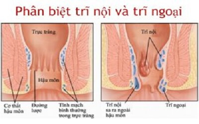 Trĩ nội và trĩ ngoại bệnh nào nặng hơn